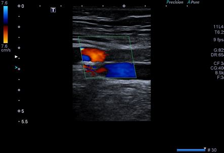 Deep Femoral Artery Ultrasound