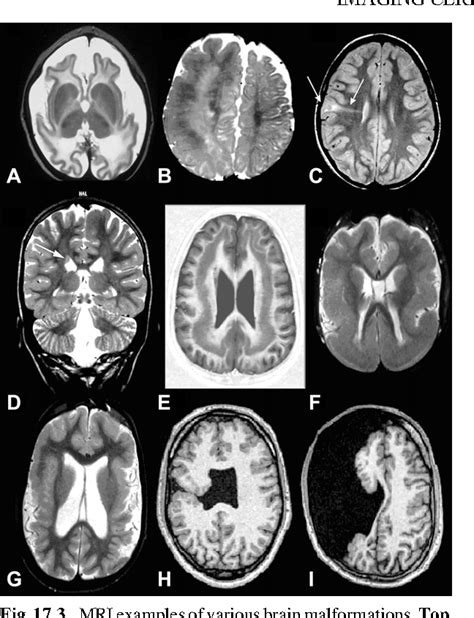 Imaging Cerebral Palsy Semantic Scholar