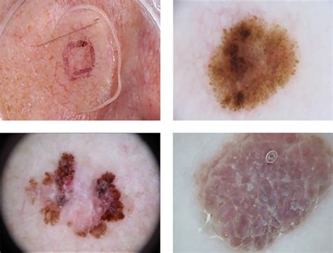 Some Images In Isic 2017 [33] The Information On Patients In Each Image