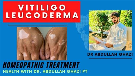 Vitiligo Leucoderma Homeopathic Treatment Dr Abdullah Ghazi Youtube