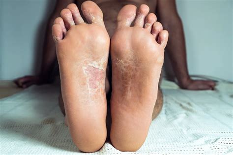 Psoriasis On Hands And Feet