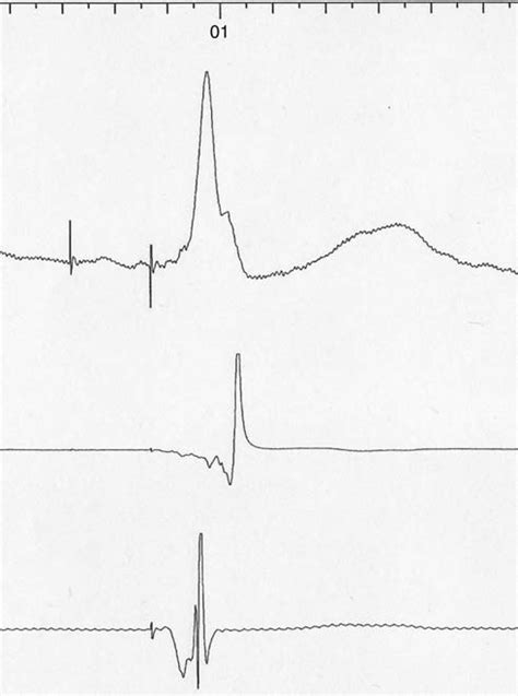 A Surface Ecg Lead Ii Lv And Rv Electrograms Recorded From A