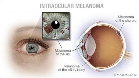 Mayo Clinic Q And A Melanoma Can Begin In The Eye Mayo Clinic News Network