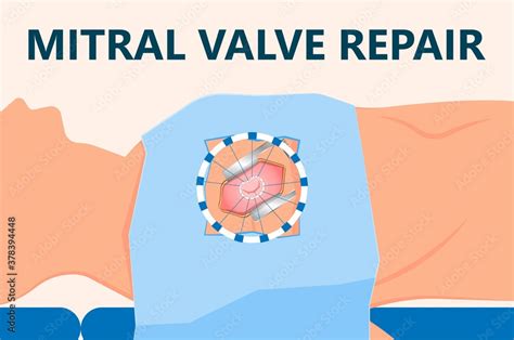 Naklejka Cath Lab Atrial Septal Defect Tetralogy Of Fallot Patent