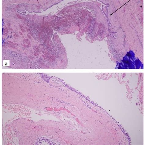 Hematoxylin And Eosin Hande Stain Showing The Thyroglossal Cyst Wall