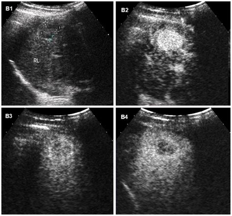 Hepatocellular Carcinoma Hcc And Liver Metastases Concise Medical