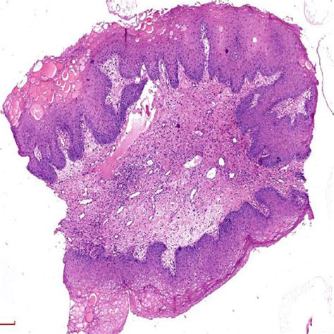 Glass Oral Pathology - Heck's Disease, Thickness: 1.2mm at ₹ 800/piece ...