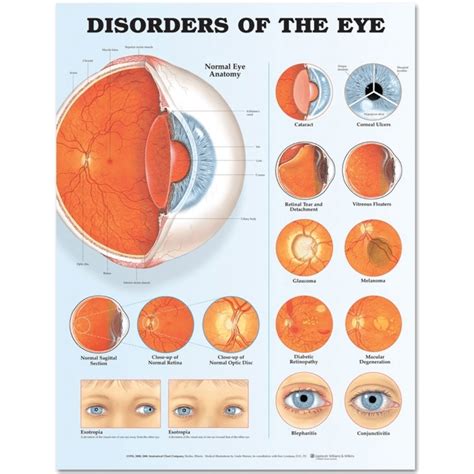 Disorders Of The Eye Anatomical Chart Disorders Of The Eye Anatomical