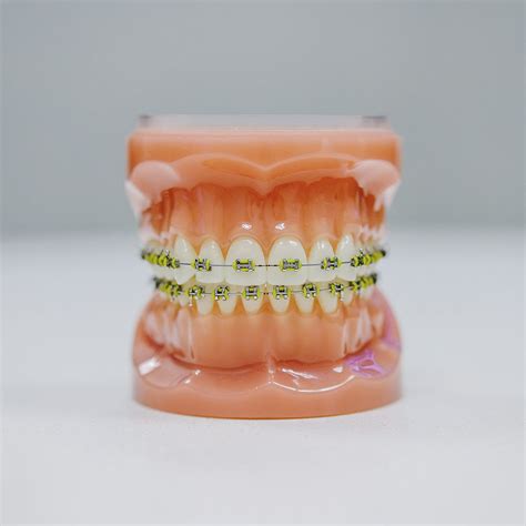 Traditional Braces For Adults | Traditional Braces | Youngquist Kennedy ...