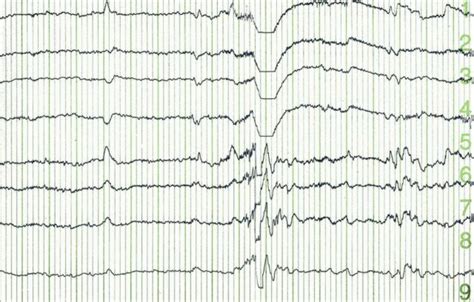 Abnormal VEEG Is A Risk Factor For Recurrence After First Unprovoked