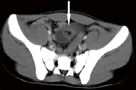 Typical Sign Of Intestinal Intussusception In Abdominal Ct Scan