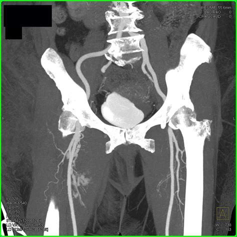 Femoral Sheath Hematoma