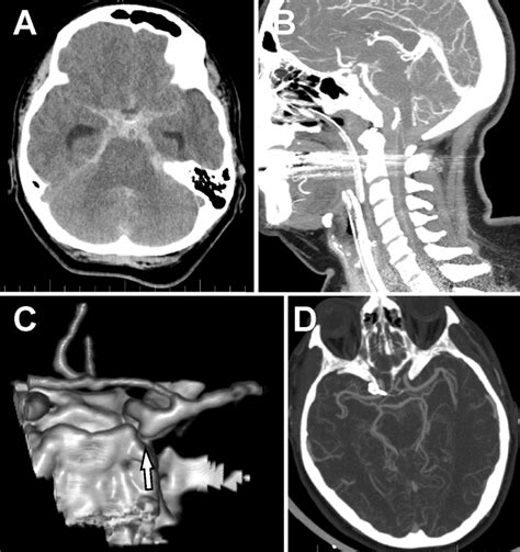 Subarachnoid Hemorrhage And The Posterior Communicating Artery Pcom