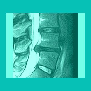 Ligamentum Flavum Hypertrophy - Herniated Disc