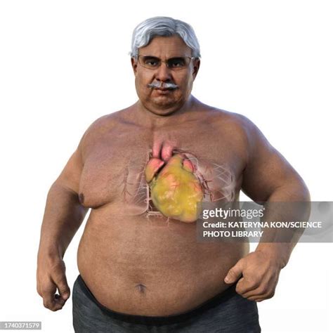 Obesity Chronic Disease Fotografías E Imágenes De Stock Getty Images