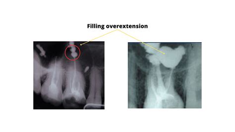 Signs Of Bad Root Canal