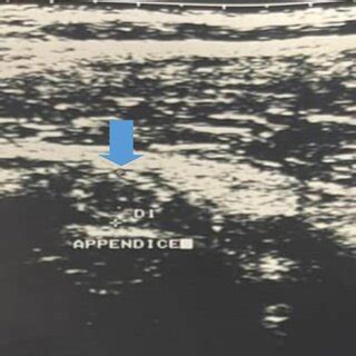 ultrasound image of an enlarged appendix (blue arrow) | Download ...