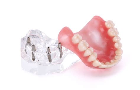 Overdentures And Removable Implant Supported Dentures