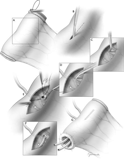 Ureteroileal Anastomosis With Intraluminal Visualization Technique And