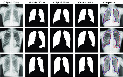 Sample Test X Ray Images Segmented Lungs Using Two U Net Models And