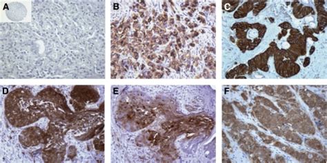 Iii Tubulin Expression In Prostate Cancers Ac Representative