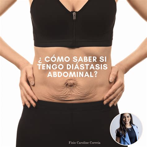 C Mo Saber Si Tengo Diastasis Abdominal Mibbmemima