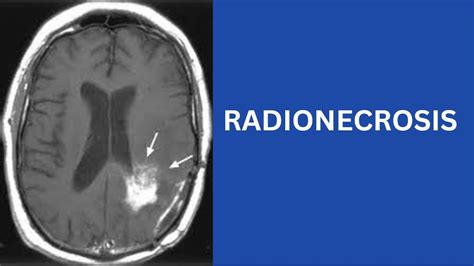 Radiation Necrosis Radiotherapy Edutech Radiotherapy Treatment Side