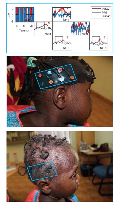 Effects Of Hair Braids On Fnirs Signal Quality In Posterior Temporal