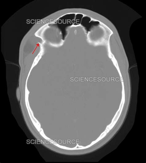 Photograph Congenital Dermoid Cyst Ct Scan Science Source Images