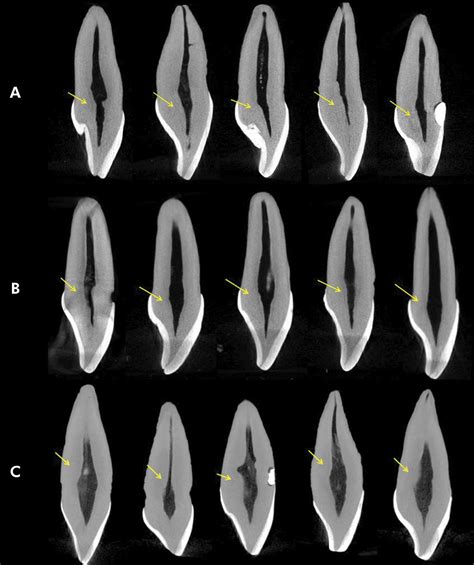 SciELO Brasil Influence Of Anatomical Features In The Endodontic