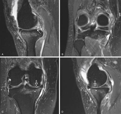 Meniscal Root Tears Musculoskeletal Key