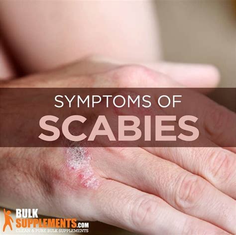 Scabies Symptoms Causes Treatment