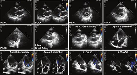 Bedside transthoracic echocardiogram (TTE) results. TTE showed ...