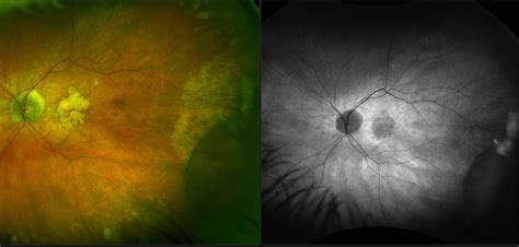 Retinoschisis - Case Study