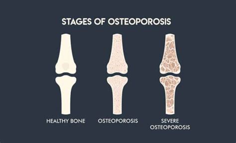 Osteoporosis Treatment – Diet Chemistry