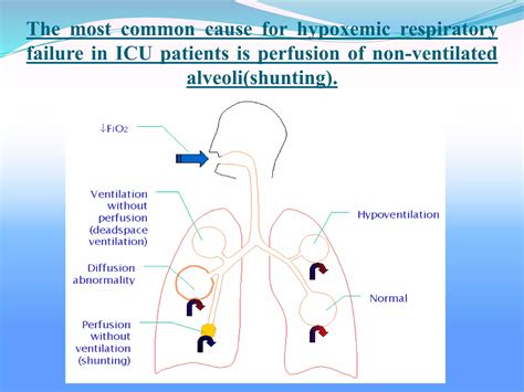 Icd 10 Code For Acute Hypoxemic Respiratory Failure 4