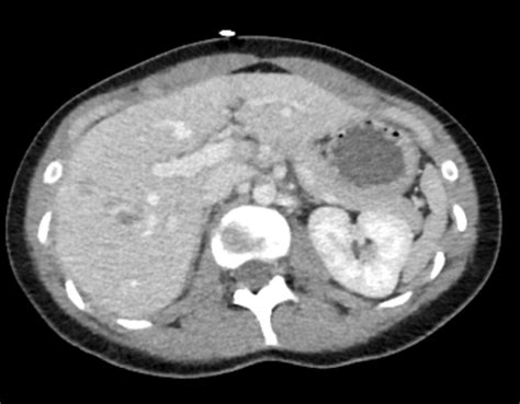 Grade 2 Liver Injury Radiology Case Radshare Net