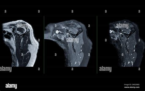 Mri Of The Shoulder Joint Sagittal View Is A Non Invasive Imaging Technique Providing Detailed