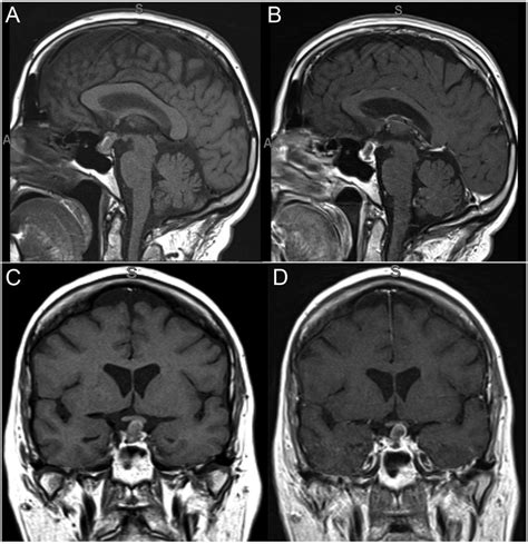 MRI pituitary: T1 sagittal view, without contrast (A) and post-contrast... | Download Scientific ...