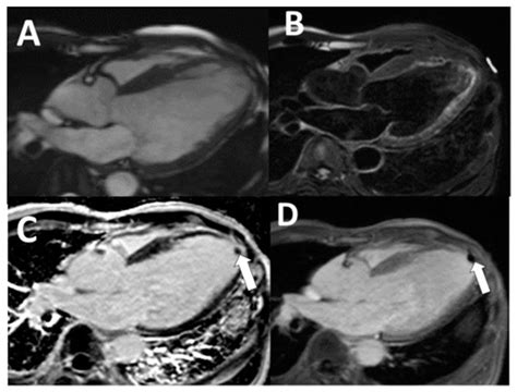 Tomography Free Full Text Left Ventricular Thrombi Insights From Cardiac Magnetic Resonance