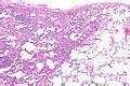 lymphocytic interstitial pneumonia libre pathology