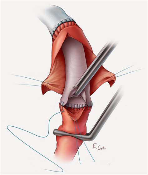 Corl Medical Media: The Elephant Trunk Procedure for Aortic Aneurysm ...