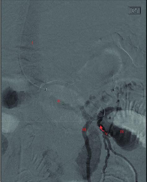 Interventional Venogram Demonstrating Portal Systemic Varix With Inflow