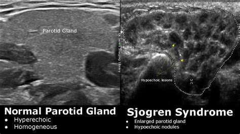 Parotid Gland Swelling Ultrasound