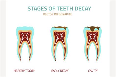 Stages of Teeth Decay ~ Illustrations on Creative Market