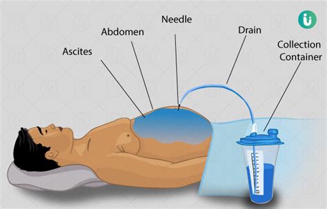 Paracentesis Fluid