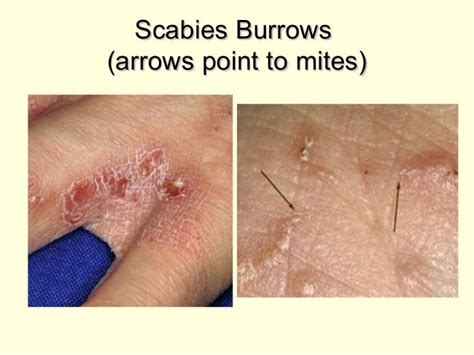 scabies tracks - pictures, photos