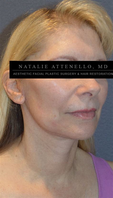 Beverly Hills Facelift Before And After Photos Los Angeles Plastic