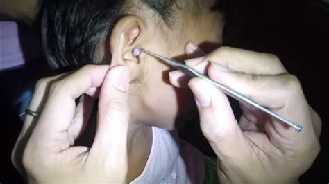 Removing A Foreign Object Bead Stuck In Girls Ear Youtube