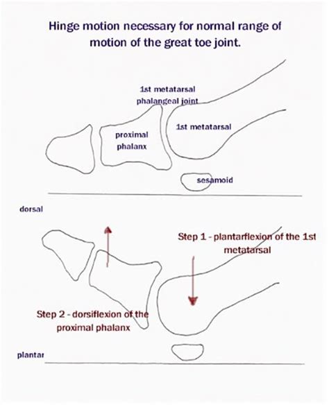 Hallux Limitus | Causes and treatment options | MyFootShop.com